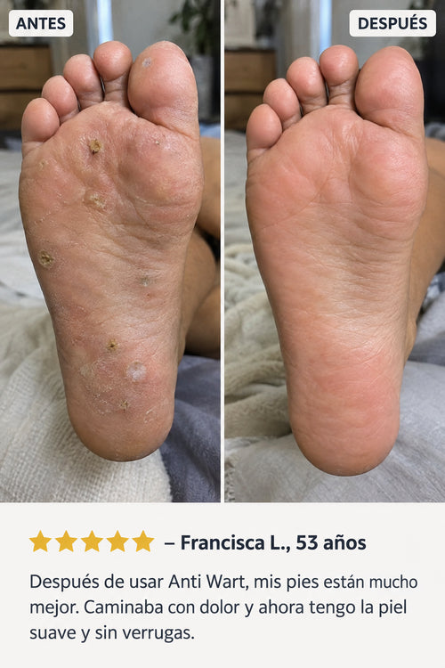 Anti Wart - Crema Anti Verrugas
