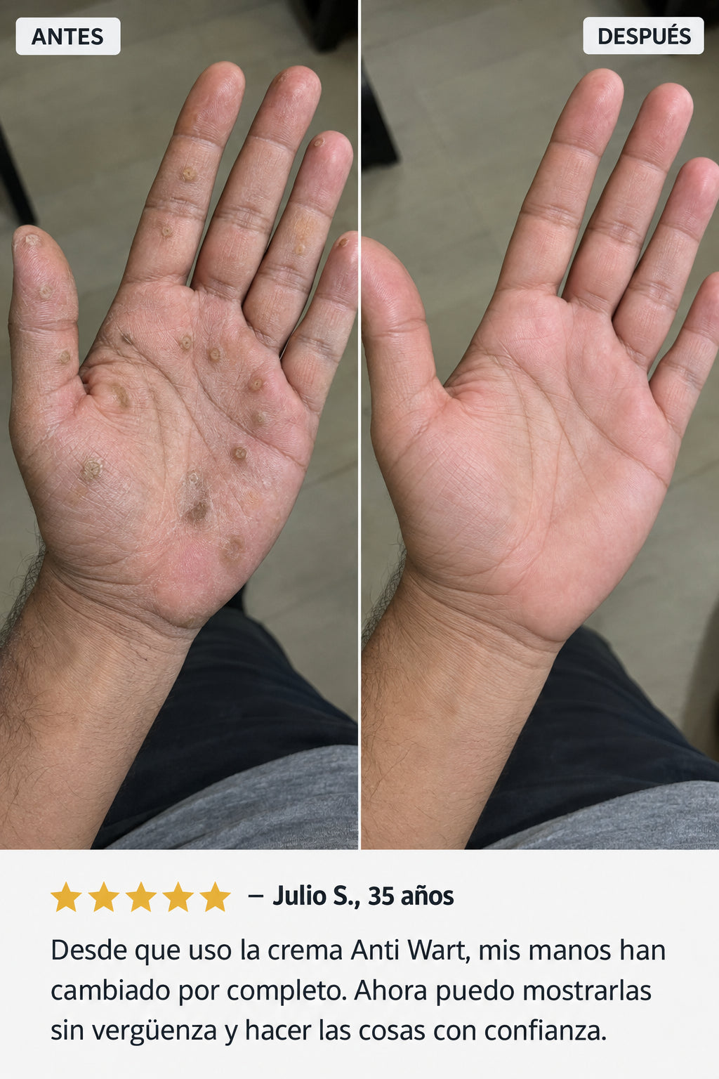 Anti Wart - Crema Anti Verrugas