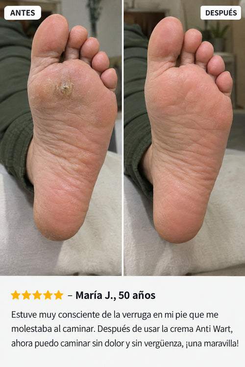 Anti Wart - Crema Anti Verrugas